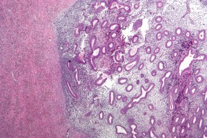 Acupuncture For Female Patients With Rheumatoid Arthritis Helps Avoid Endometriosis