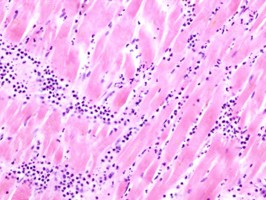 Jing-Well Acupuncture Point Bloodletting Potentially Mediates Covid Induced Cardiac Issues