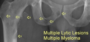 Multiple Myeloma Maintained with Chinese Herbal Medicine Treatment Alone (Case Study)