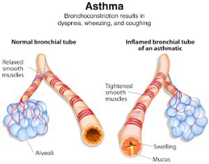 Study Explores Anti-Asthmatic Effects Of Moxibustion