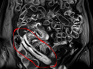 The Inner Workings of Herb-Partitioned Moxibustion For Crohn's Disease